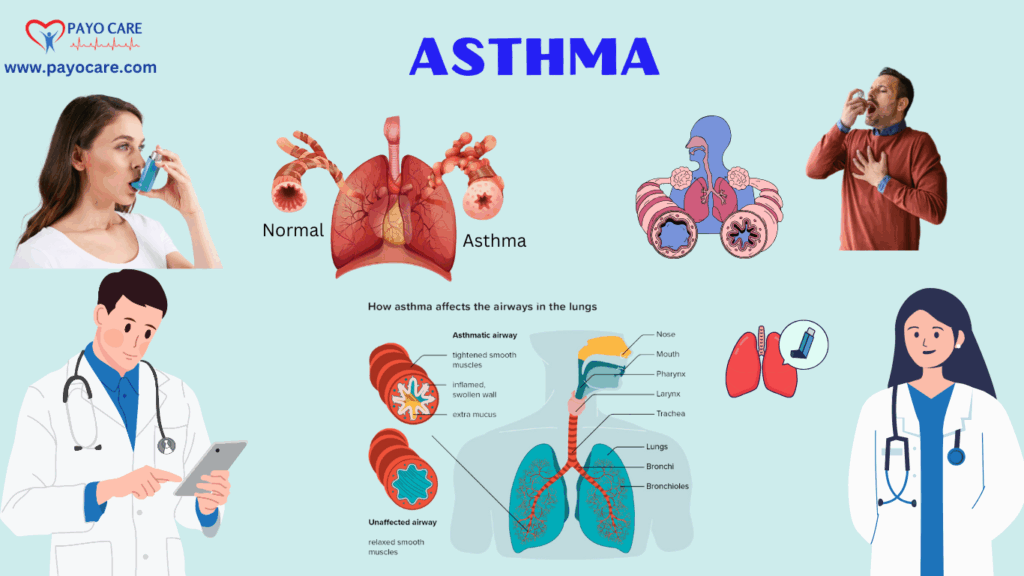 Asthma: Types, Causes, Symptoms, Diagnosis & Treatment Asthma: Types, Causes, Symptoms, Diagnosis & Treatment
