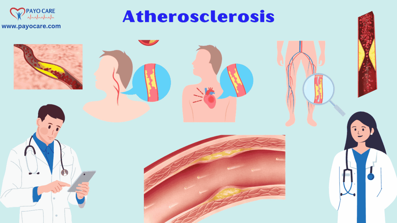 Atherosclerosis :Types, Causes, Symptoms, Prevention, Diagnosis & Treatment