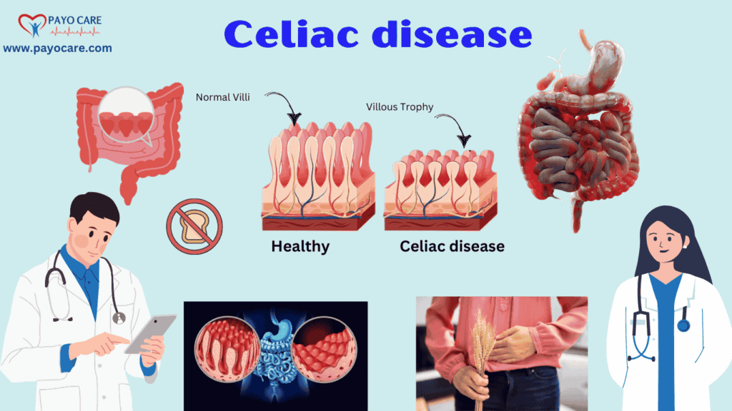 Celiac disease :Types, Causes, Symptoms, Prevention, Diagnosis & Treatment Celiac disease :Types, Causes, Symptoms, Prevention, Diagnosis & Treatment