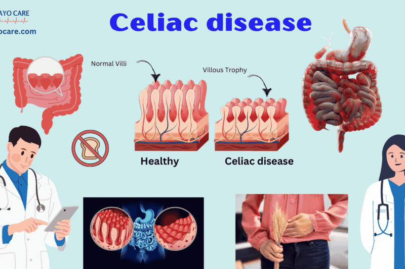 Celiac disease :Causes, Symptoms, Prevention & Treatment