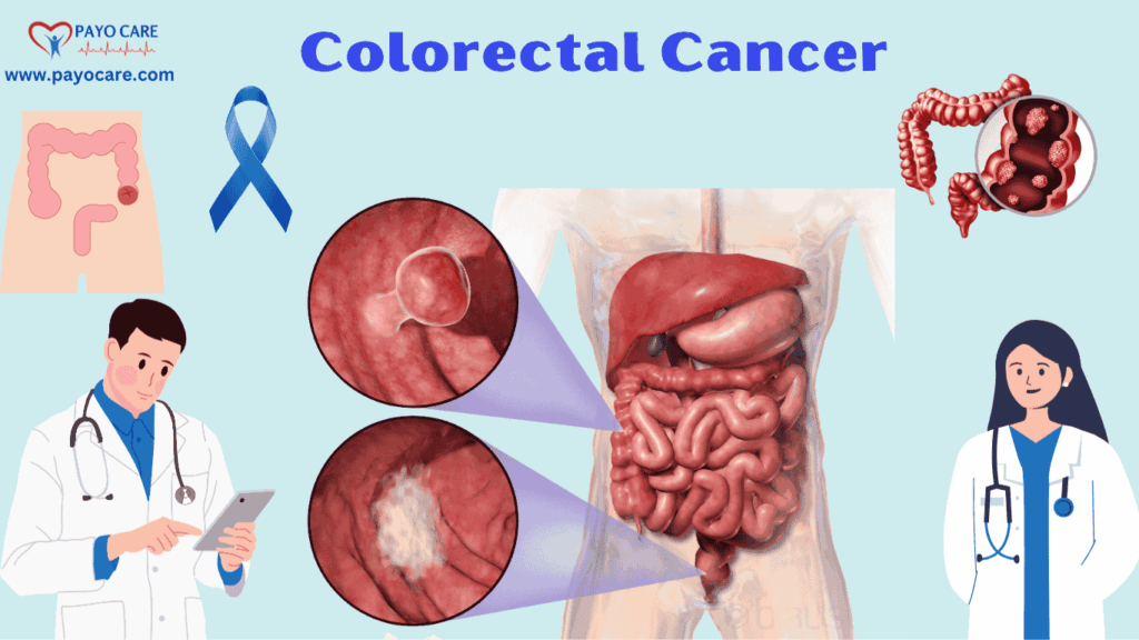 Colorectal Cancer: Causes, Symptoms & Preventions