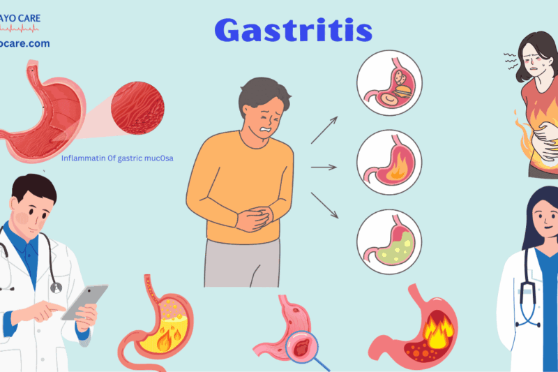 Gastritis: Causes, Symptoms, Prevention & Treatments