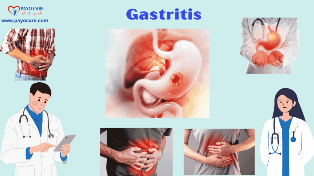 Gastritis: Types, Causes, Symptoms, Prevention, Diagnosis, and Treatments