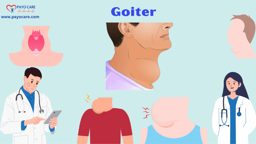 Goiter: Types, Causes, Symptoms, Prevention, Diagnosis, and Treatments