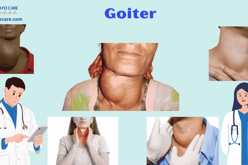 Goiter: Types, Causes, Symptoms, Prevention,