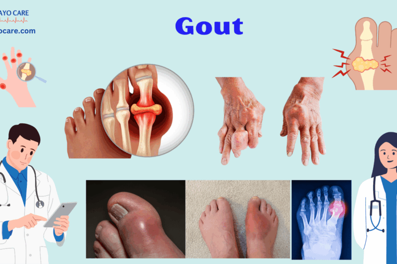 Gout: Causes, Symptoms, Prevention & Treatment