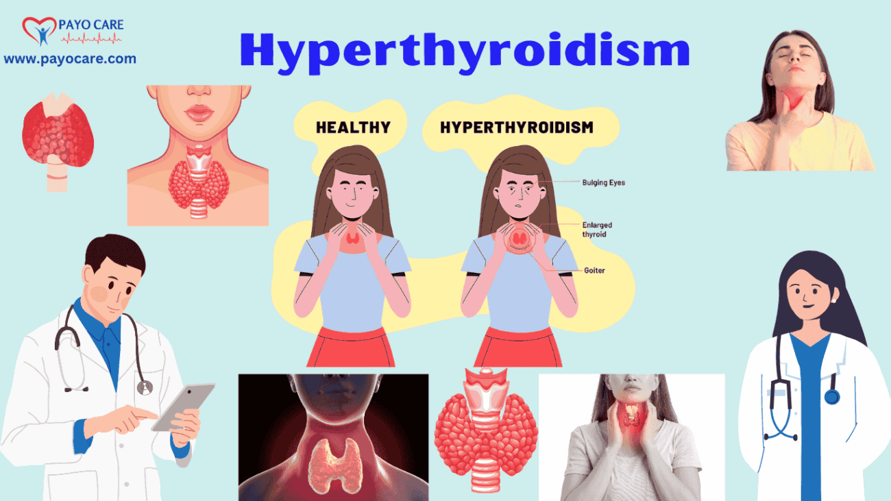 Hyperthyroidism Types, Causes, Symptoms, Prevention, Diagnosis & Treatment
