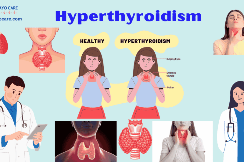 Hyperthyroidism: Types, Causes, Symptoms & Treatment