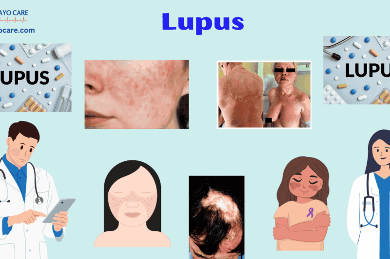 Lupus :Causes, Symptoms, Prevention & Treatment