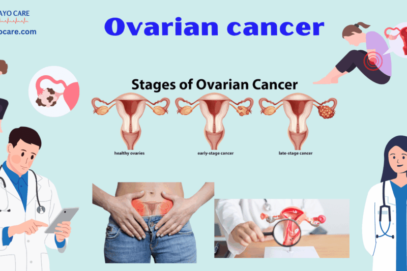 Ovarian Cancer: Causes, Symptoms, Prevention & Treatment