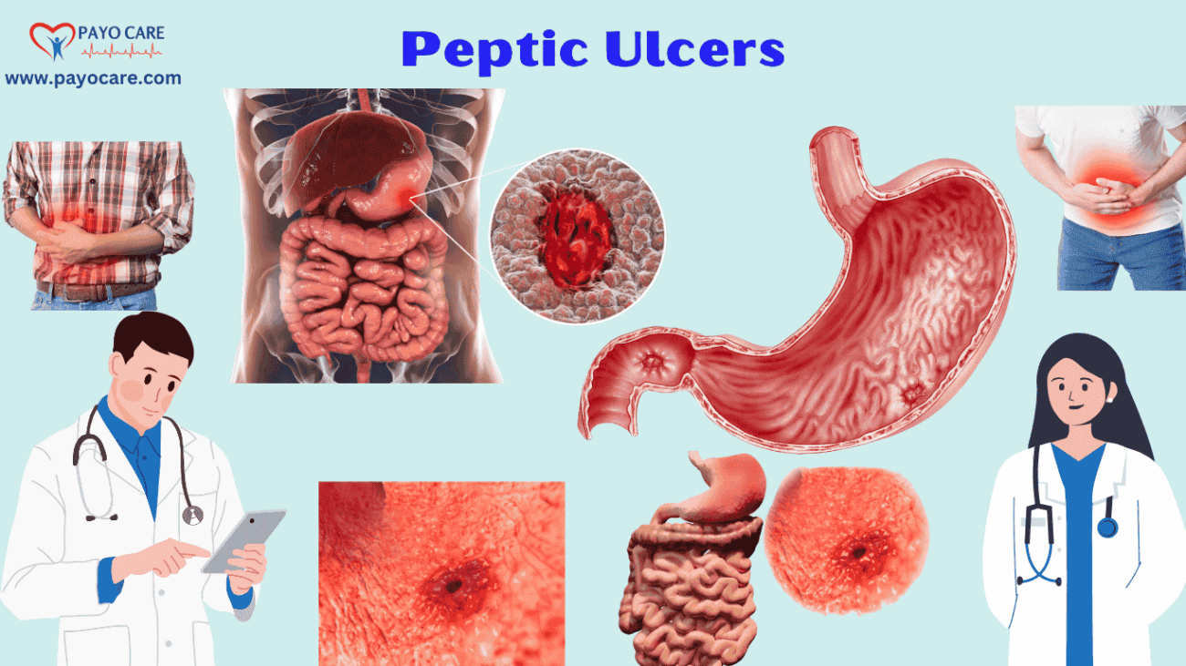 Peptic Ulcers: Types, Causes, Symptoms, Prevention, Diagnosis & Treatment