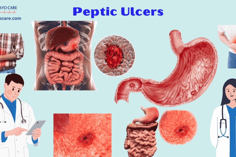 Peptic Ulcers :Causes, Symptoms & Treatment