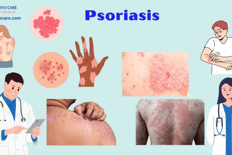 Psoriasis:Causes, Symptoms & Treatment