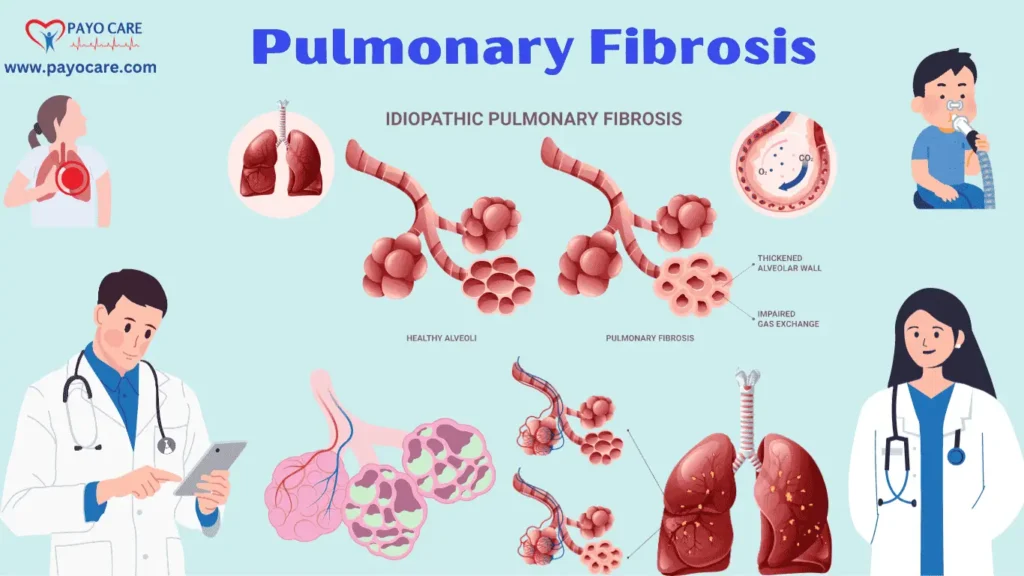 Pulmonary Fibrosis: Types, Causes, Symptoms & Treatments