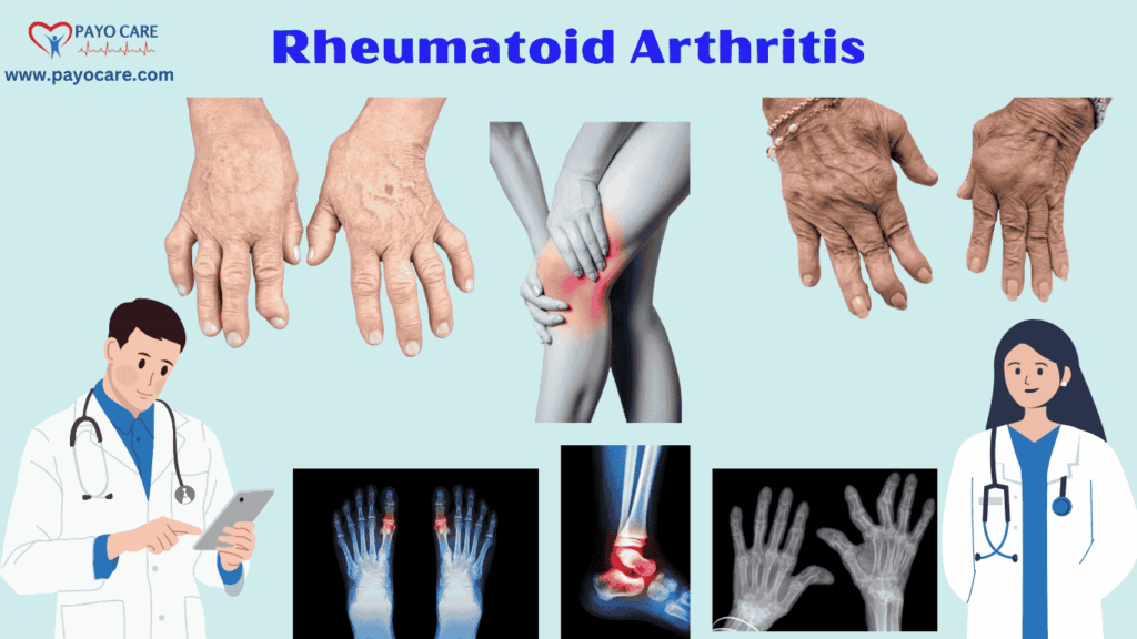 Rheumatoid Arthritis :Types, Causes, Symptoms, Prevention, Diagnosis & Treatment