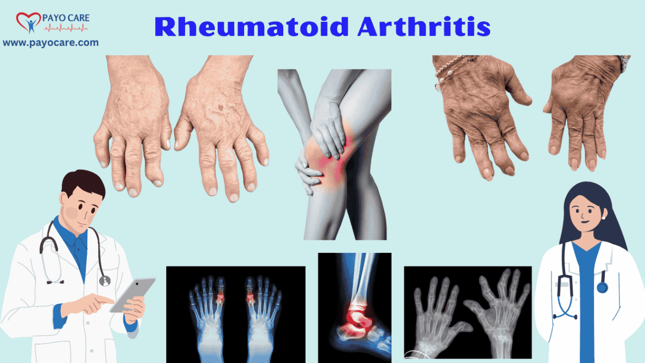 Rheumatoid Arthritis :Types, Causes, Symptoms, Prevention, Diagnosis & Treatment
