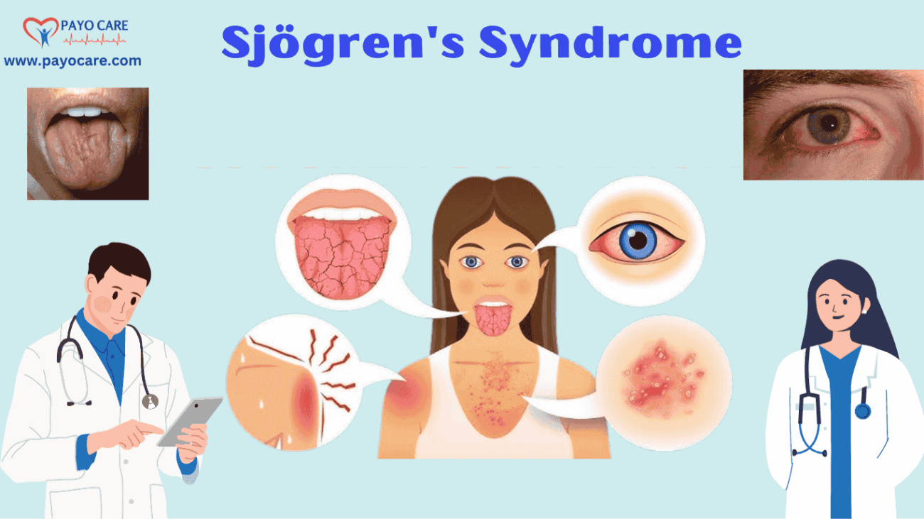 Sjögren's Syndrome: Causes, Symptoms