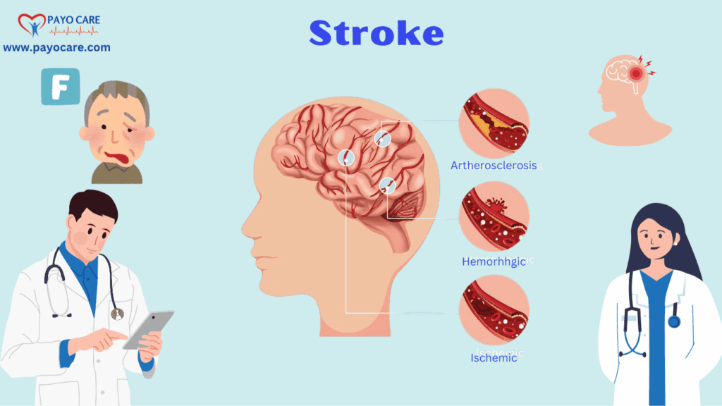  Stroke Causes and Symptoms