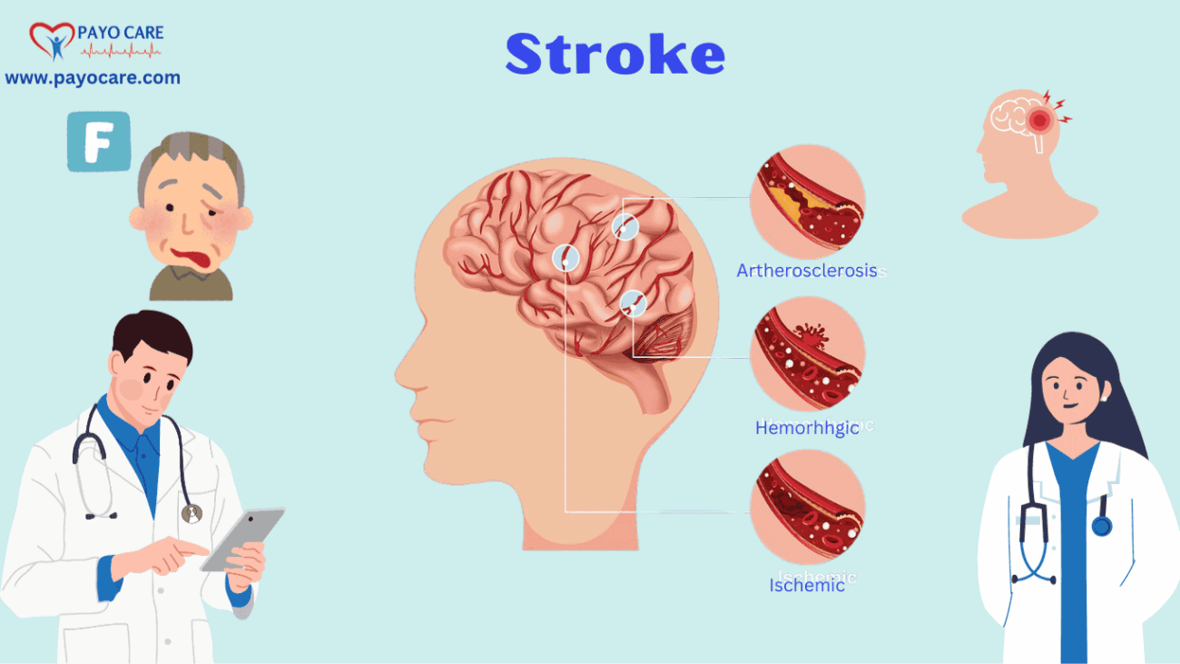 Stroke Causes and Symptoms