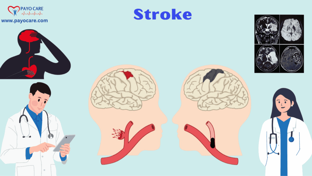 Stroke: Causes, Symptoms & Prevention