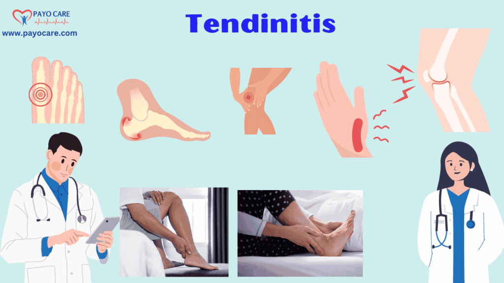Tendinitis: Types, Causes, Symptoms, Prevention, Diagnosis & Treatment