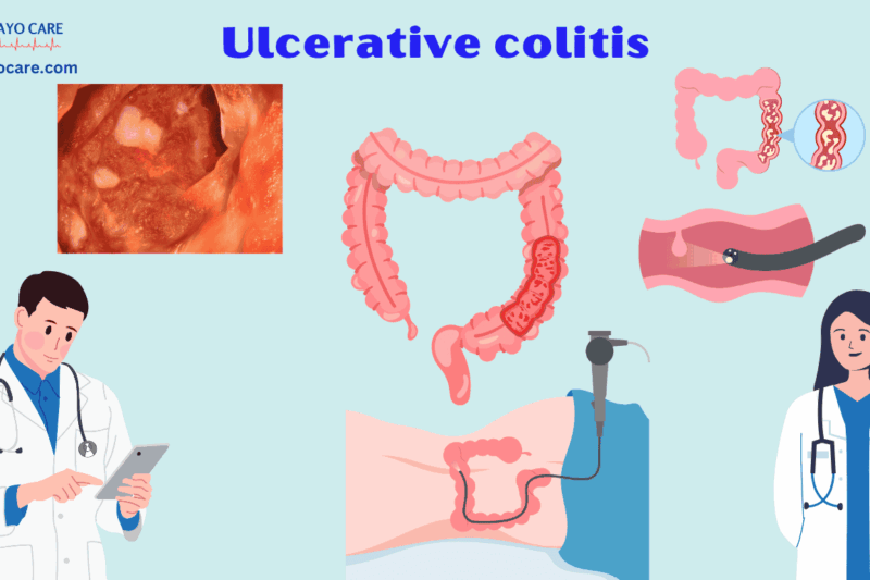 Ulcerative Colitis: Causes, Symptoms & Treatment