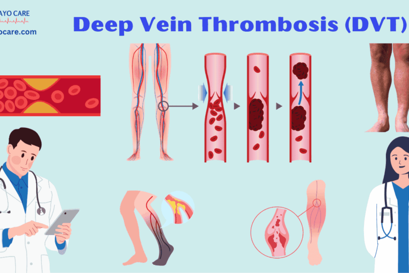 Deep Vein Thrombosis (DVT): Causes, Symptoms and Treatments