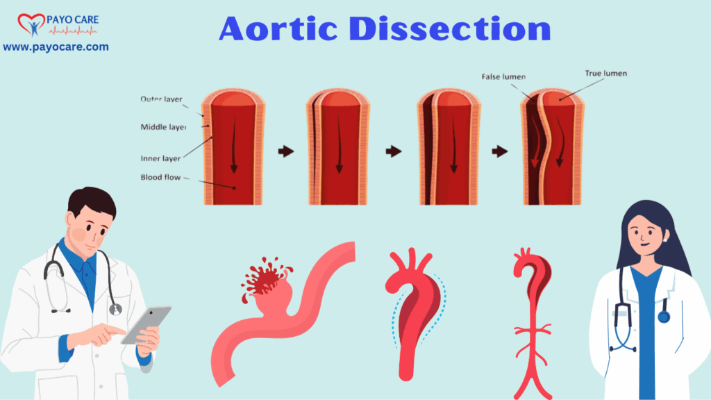 Aortic Dissection: Types, Causes, Symptoms, Prevention, Diagnosis, and Treatment