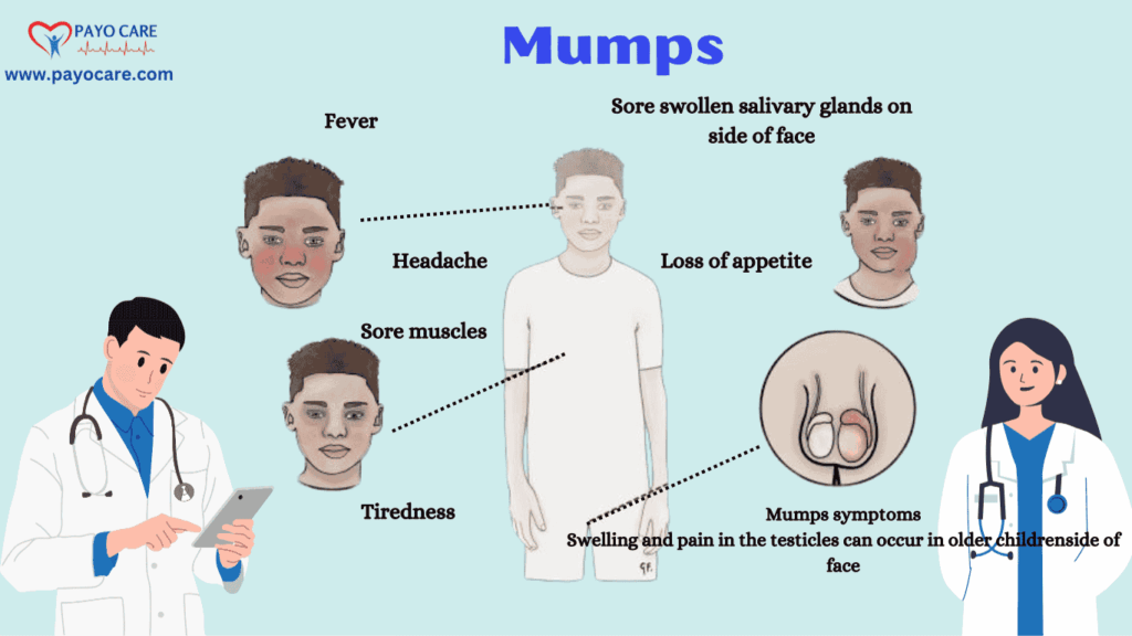 Mumps: Causes, Symptoms, prevention and Treatment