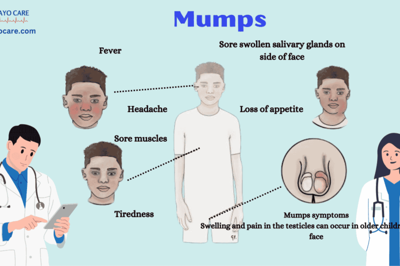 Mumps: Causes, Symptoms, prevention and Treatment