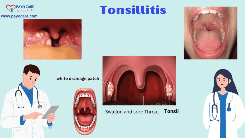 Tonsillitis: Types, Causes, Symptoms, Prevention, and Treatment