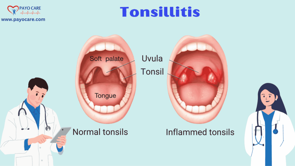 Tonsillitis: Types, Causes, Symptoms, Prevention, Diagnosis, and Treatment