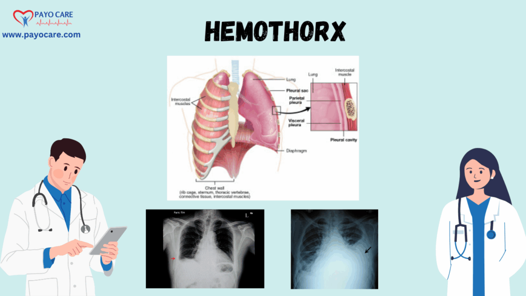 Hemothorax: Types, Causes, Symptoms, Prevention, Diagnosis, and Treatment
