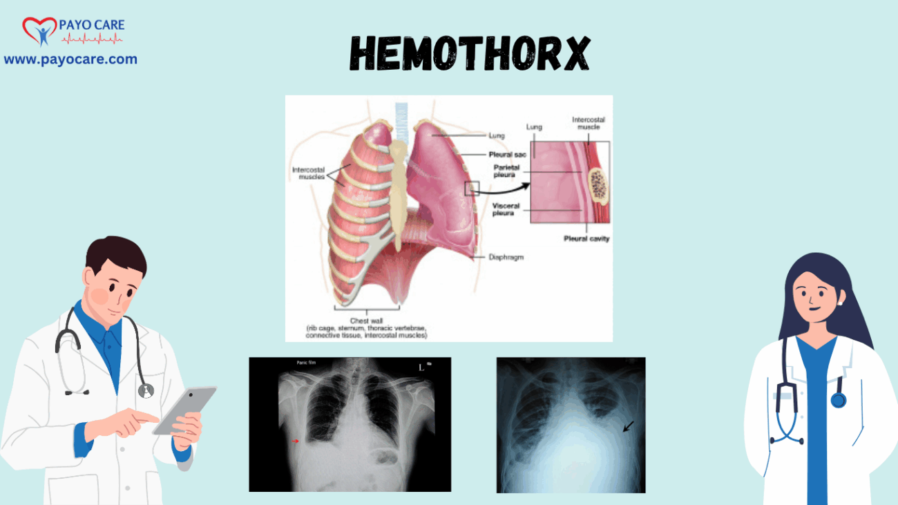 Hemothorax: Types, Causes, Symptoms, Prevention, Diagnosis, and Treatment