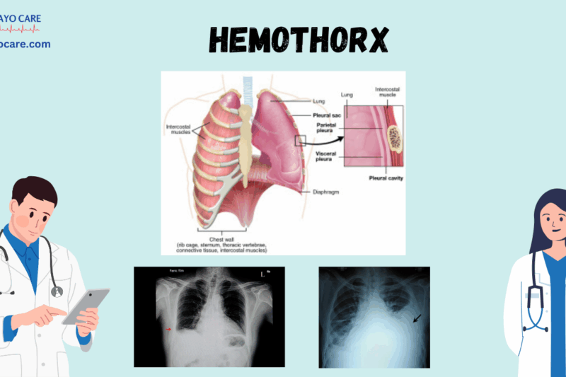 Hemothorax: Types, Causes, Symptoms, Prevention, Diagnosis, and Treatment