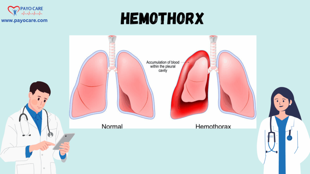 Hemothorax: Types, Causes, Symptoms, Prevention, and Treatment