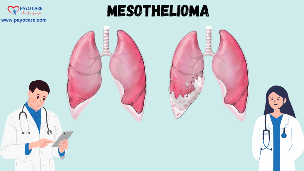 Mesothelioma :Types, Causes, Symptoms, Prevention, Diagnosis, and Treatment
